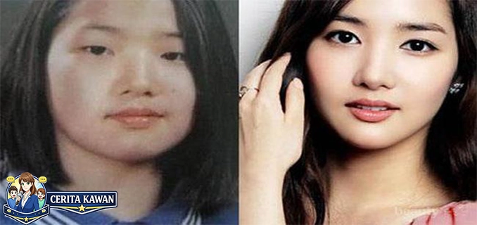 Kisah Aktris Korea yang Wajahnya Hancur karena Oplas